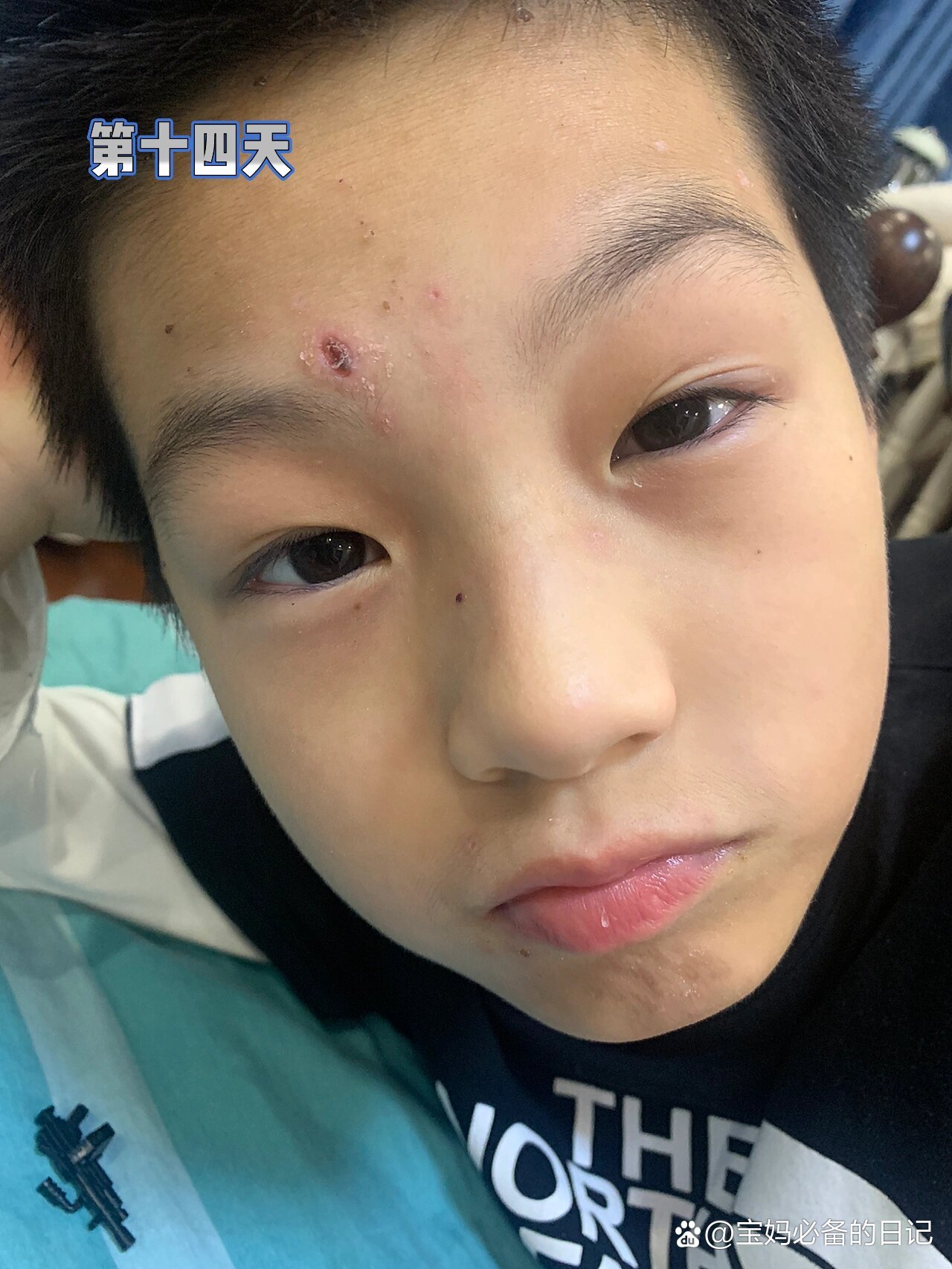 「沈阳1例新冠康复患者复阳」〃沈阳一例新冠肺炎患者复阳