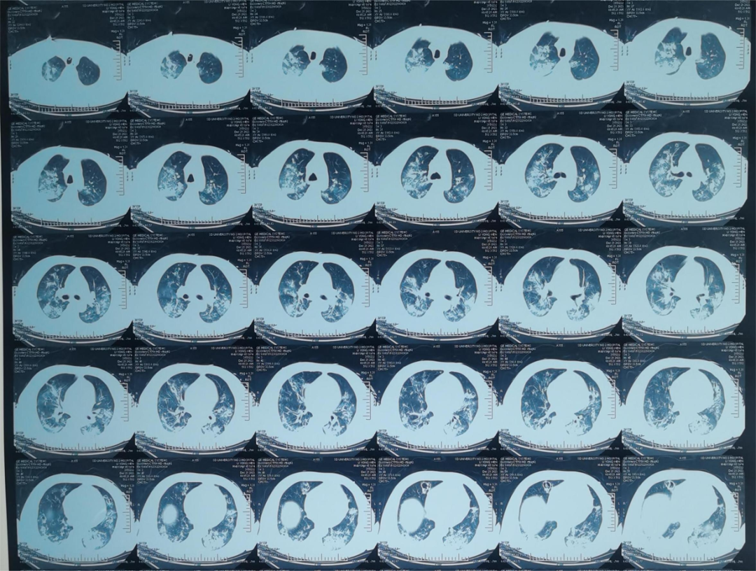 韩国现双重感染病例︰(韩国现双重感染病例最新消息)-第1张图片